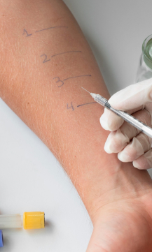 Sclerotherapy for spider veins