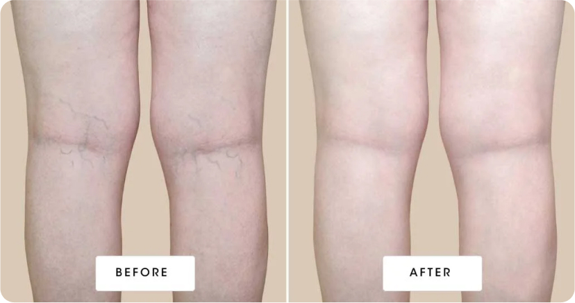 Before & After Vein Treatment