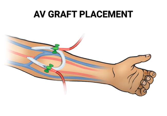 AV Graft Placement