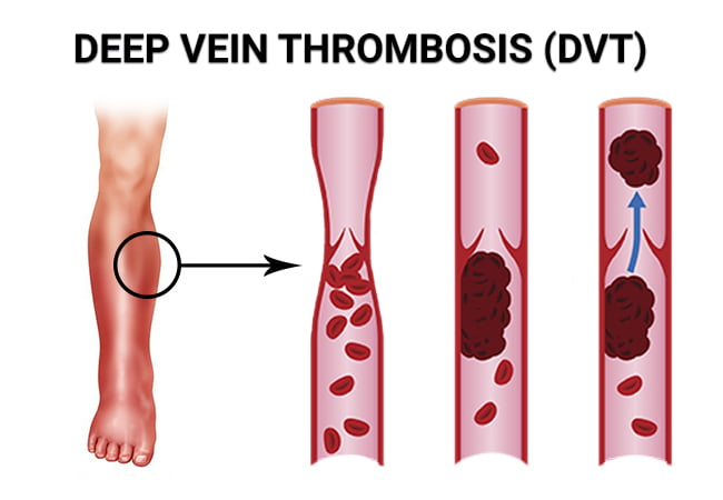 Deep Vein Thrombosis