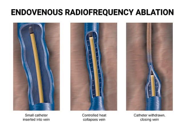 Endovenous Radiofrequency Ablation