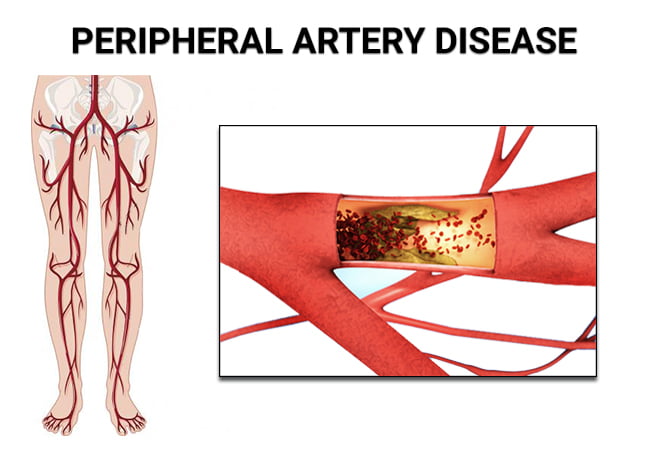Peripheral Artery Disease