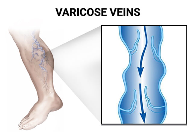 Varicose Veins