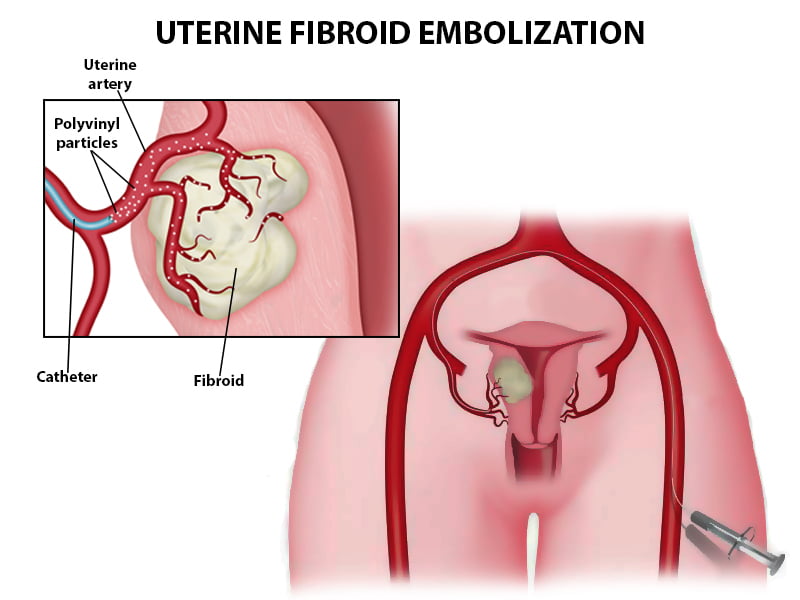 Anatomy of uterine fibroid embolization