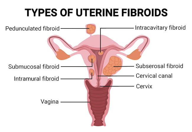 Types of Uterine Fibroids