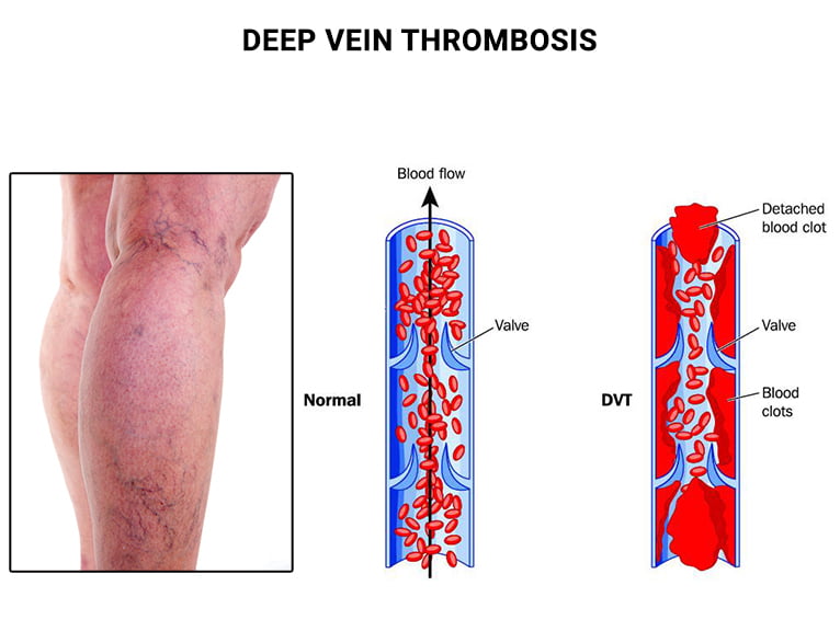 Deep Vein Thrombosis