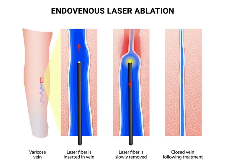 Endovenous Laser Ablation