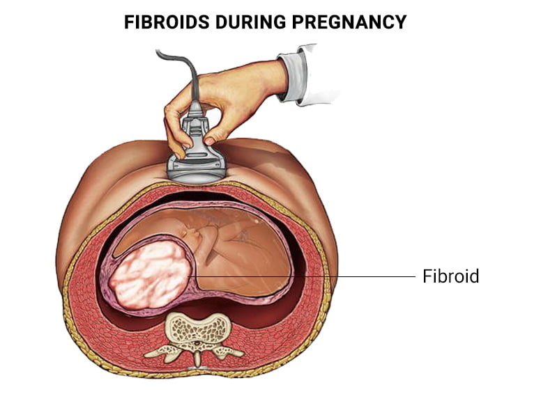 Fibroids During Pregnancy