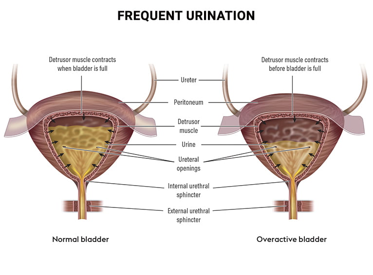 Frequent Urination