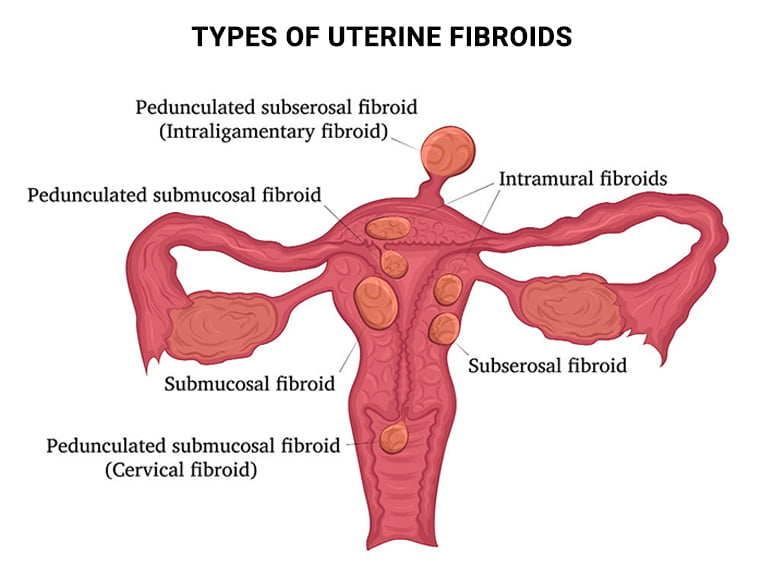Types of fibroids