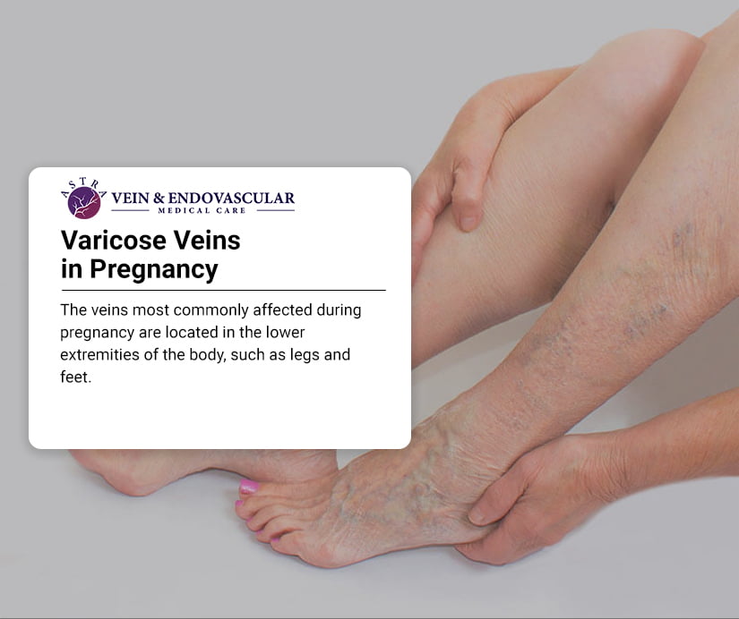 Varicose Veins in Pregnancy