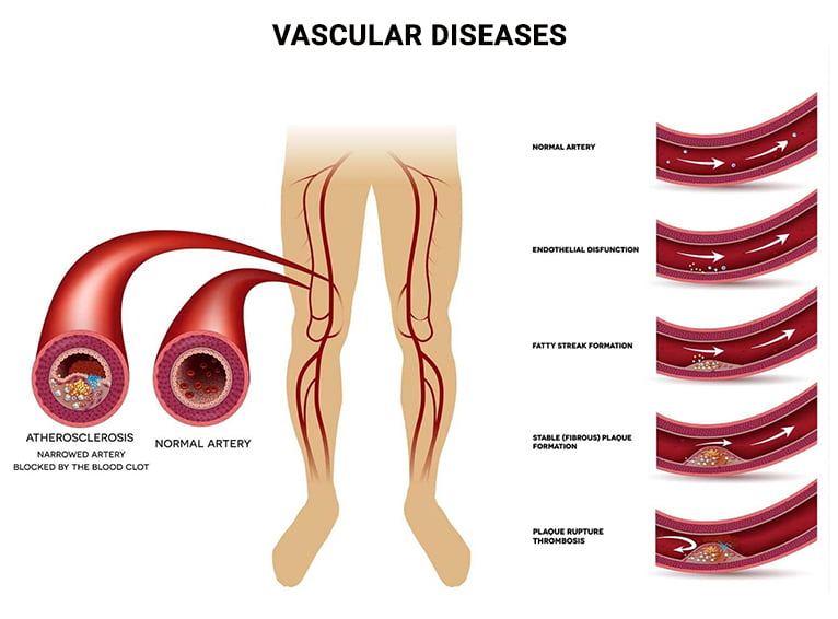 Vascular Diseases