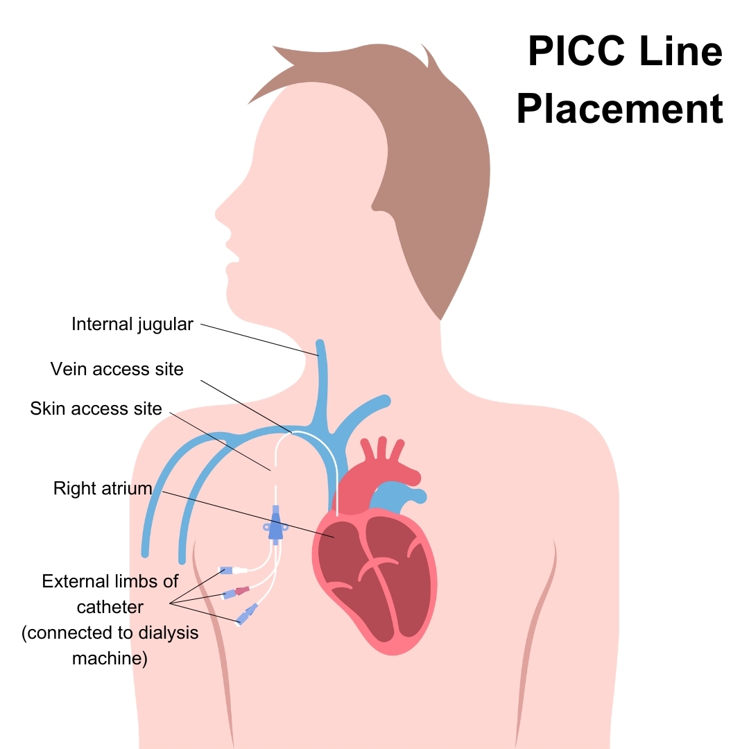 PICC line placement
