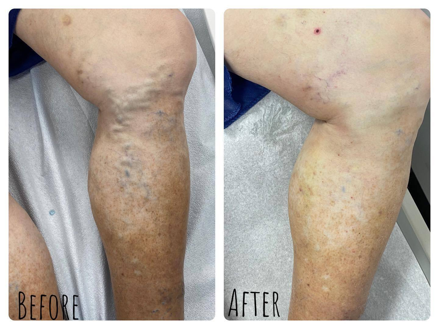 Varicose Veins Removal Before and After