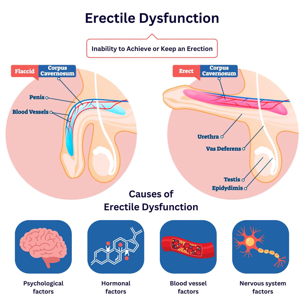 Erectile Dysfunction