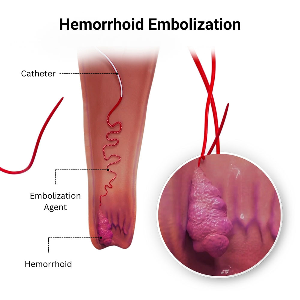 Hemorrhoid Embolization in Brooklyn Bronx