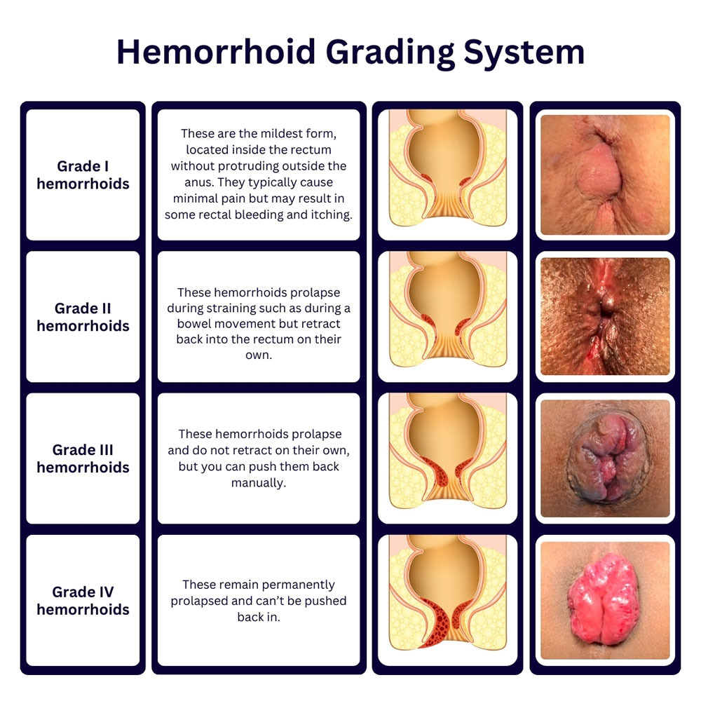 Hemorrhoid Grading System