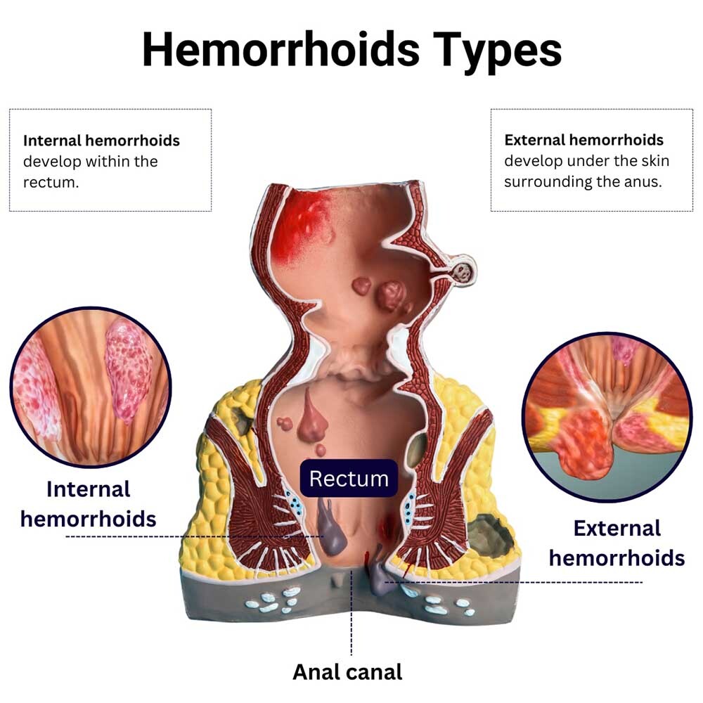 Hemorrhoids Types