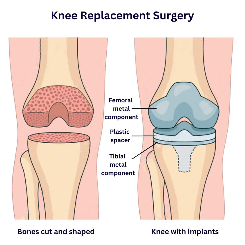 Knee Replacement Surgery
