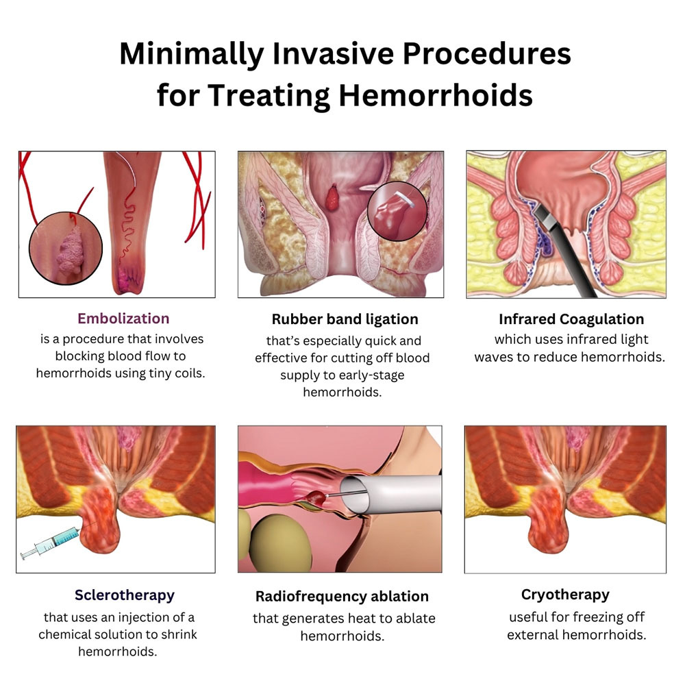 Minimally Invasive Procedure for Treating Hemorrhoid in Brooklyn